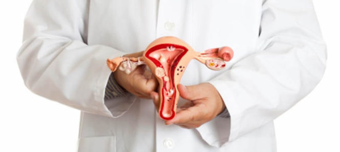 Fibromatosis uterina
