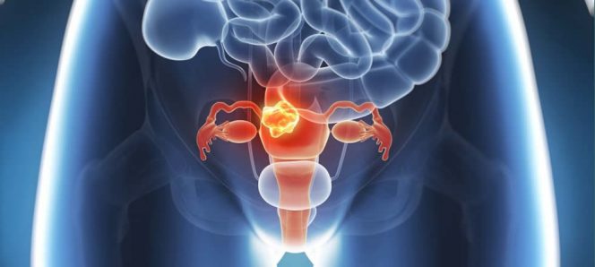 los fibromas uterinos