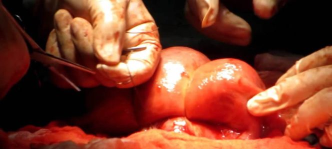 Atonía uterina en el posparto