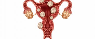 Fibromas uterinos