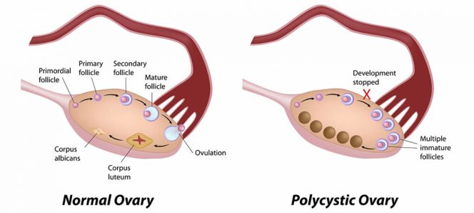 polycystic ovary